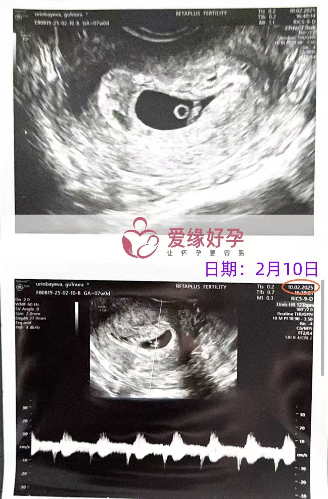 格鲁吉亚代孕代孕代母25周产检顺利通过