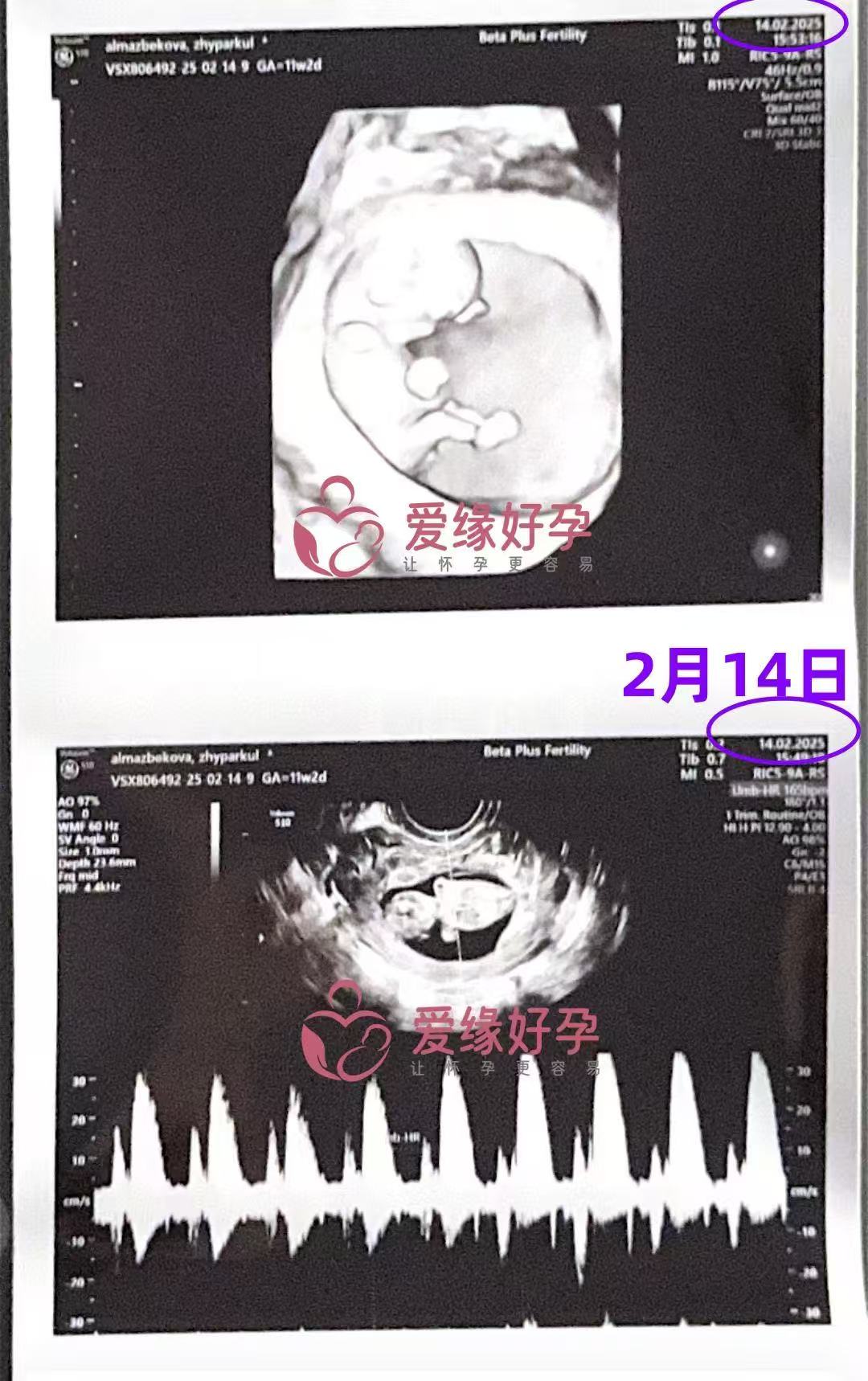 格鲁吉亚代孕代孕代母11周产检顺利通过