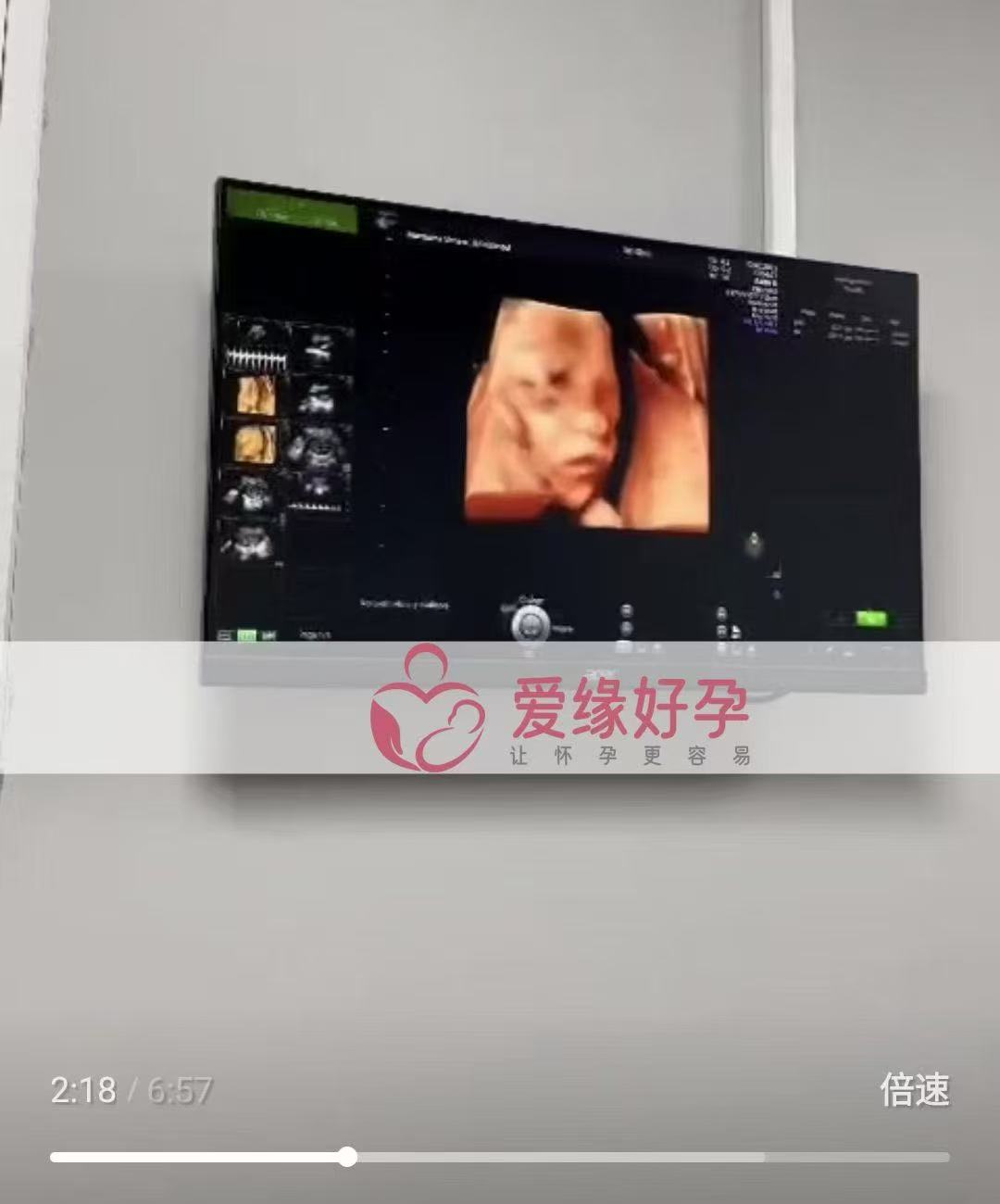 格鲁吉亚代孕代孕代母成功度过风险期
