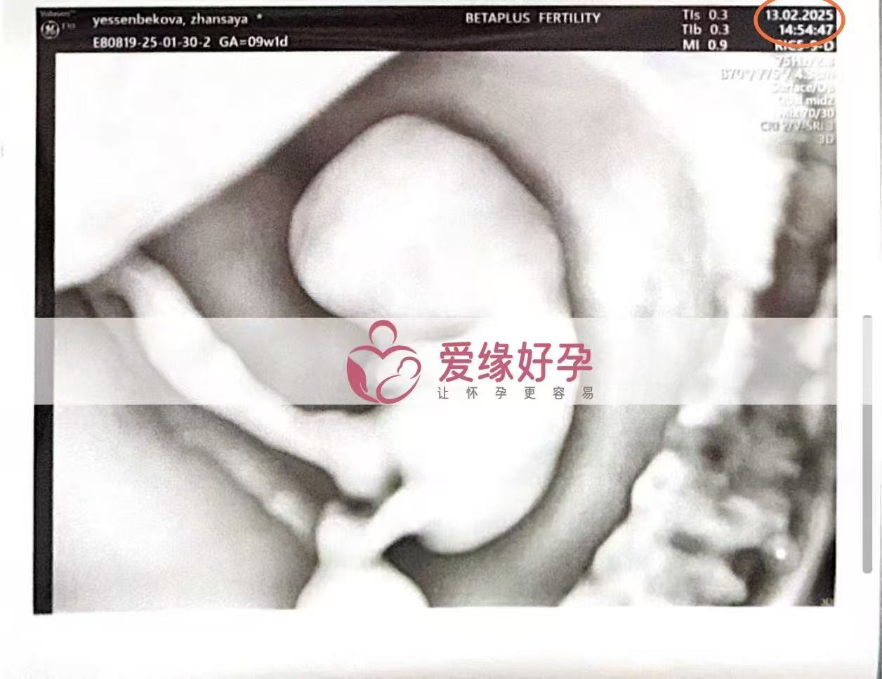 格鲁吉亚代孕代孕代母9周产检顺利通过