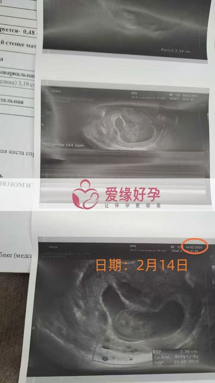 格鲁吉亚代孕代孕代母14周产检结果安好