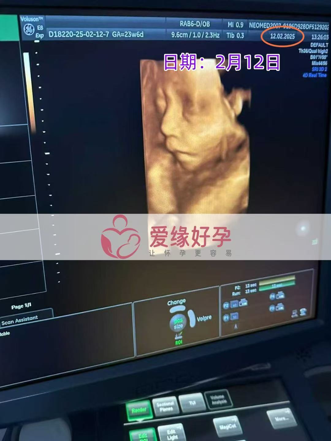 乌克兰代孕代孕代母24周成功通过产检