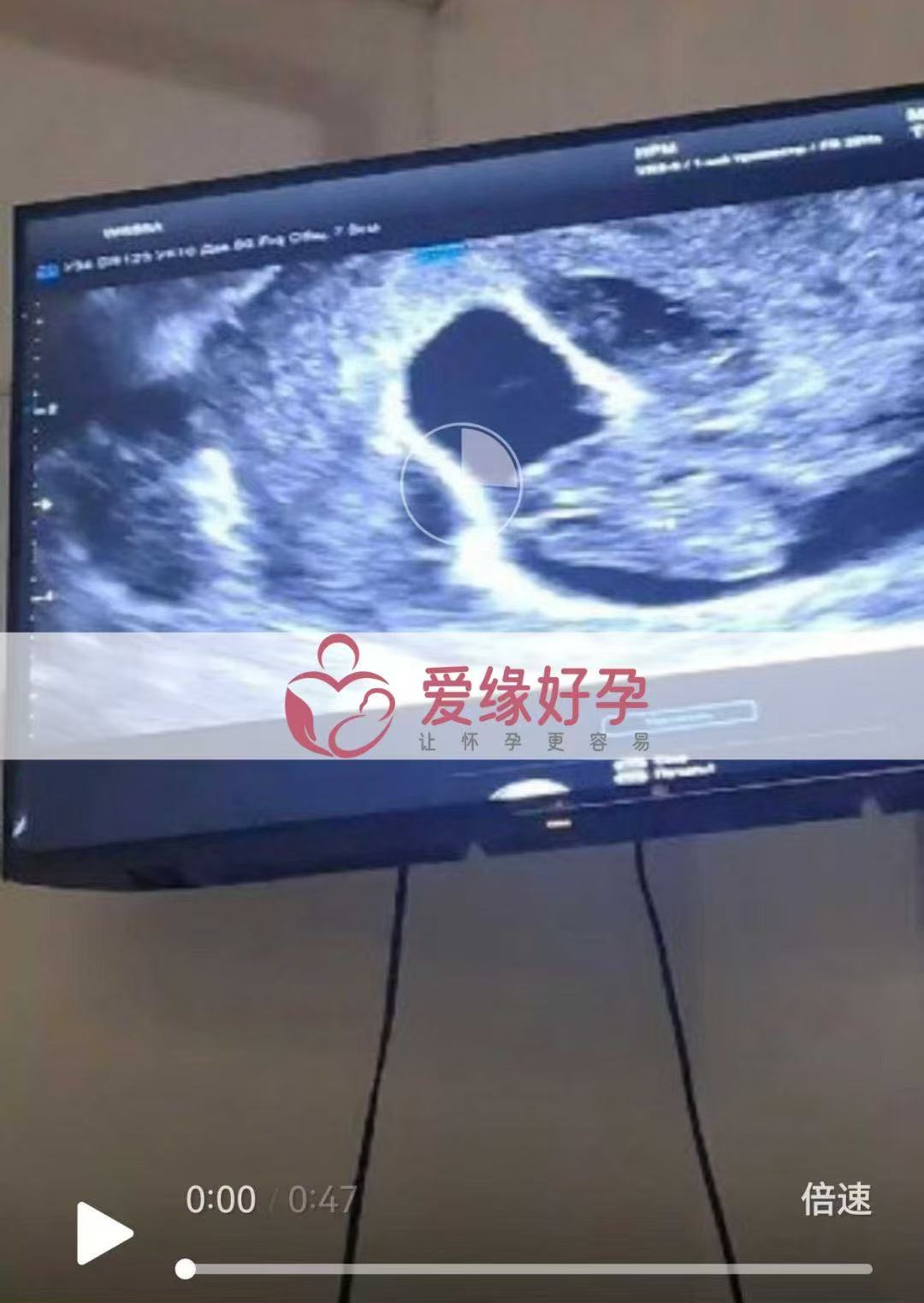 格鲁吉亚代孕代孕代母14周产检结果安好