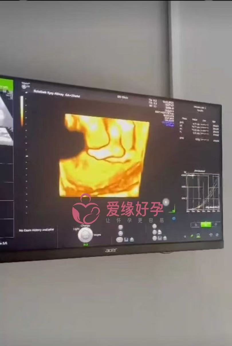 格鲁吉亚代孕代孕代母成功通过20周产检