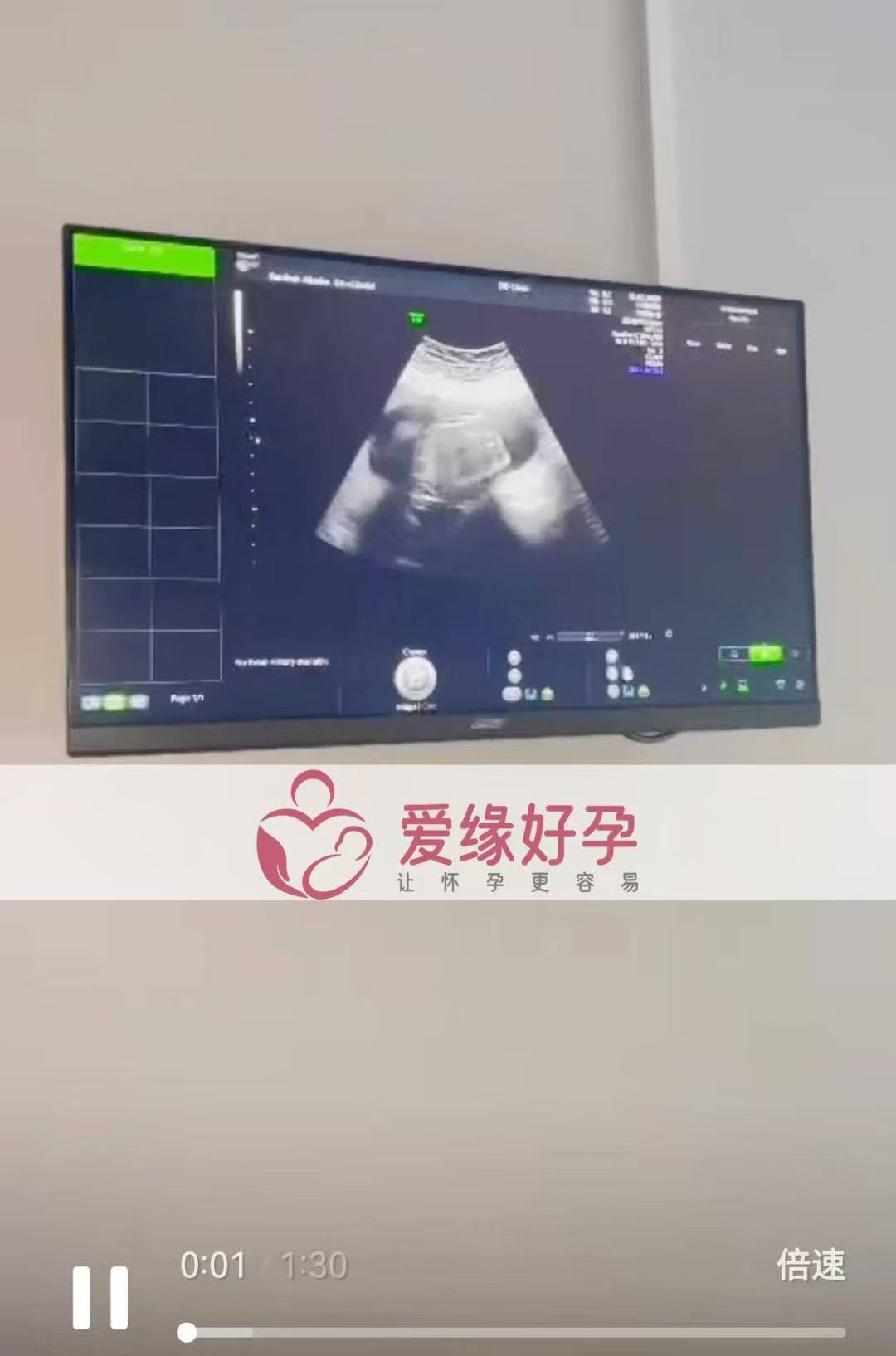格鲁吉亚代孕代孕代母18周产检顺利通过