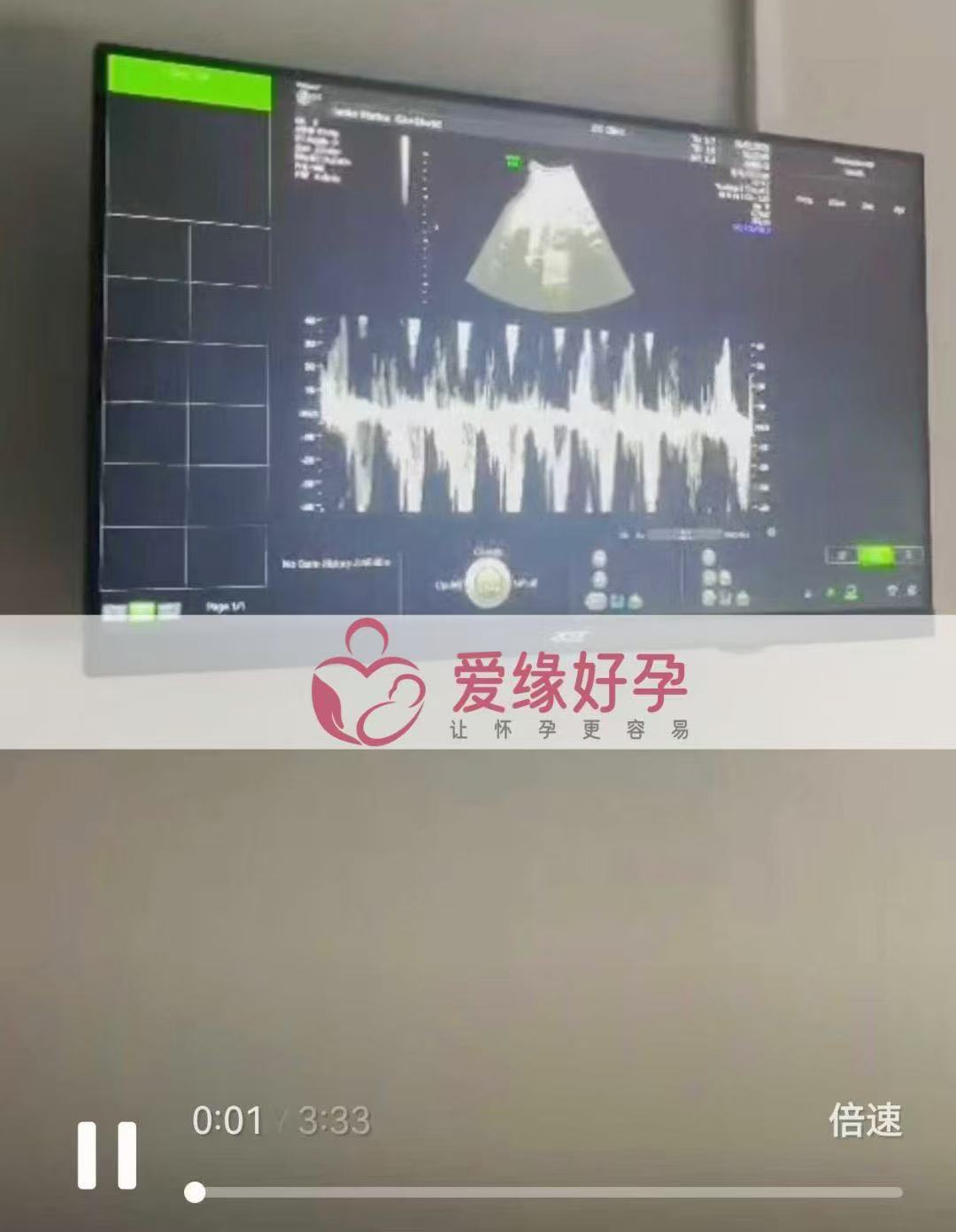 格鲁吉亚代孕代孕代母即将迎接新生命诞生