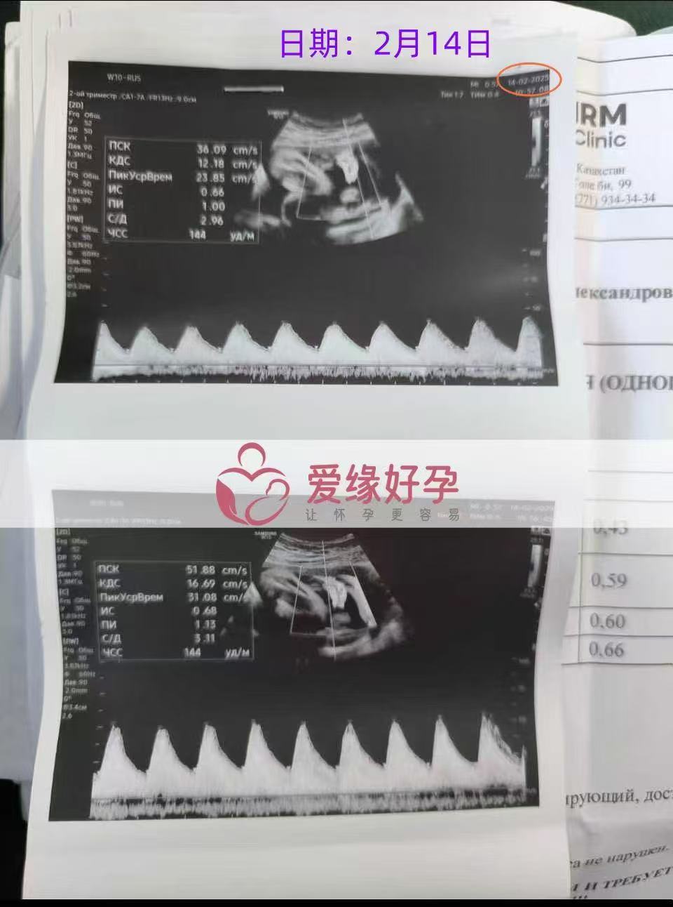 哈萨克斯坦代孕代孕代母32周产检顺利通过