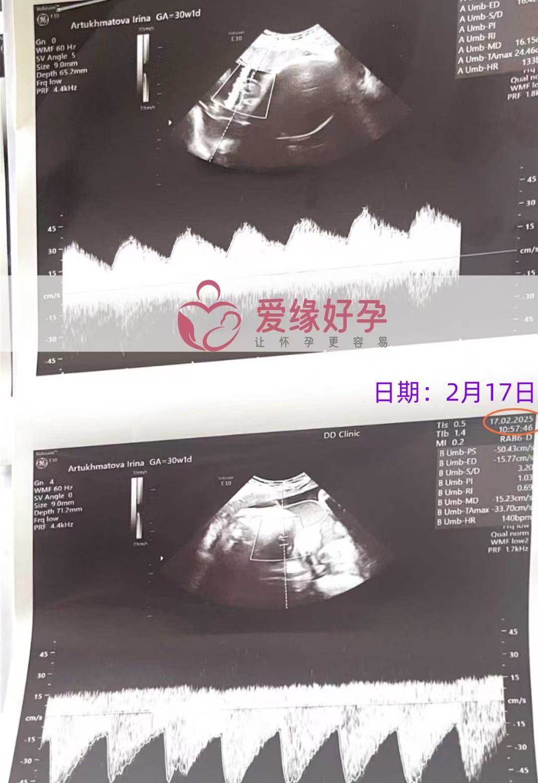 格鲁吉亚代孕代孕代母顺利完成30周产检