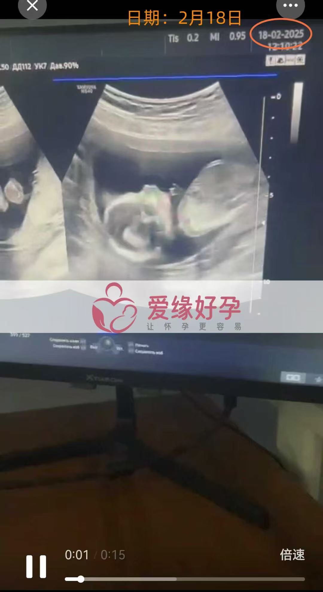 格鲁吉亚代孕代孕代母15周产检顺利通过