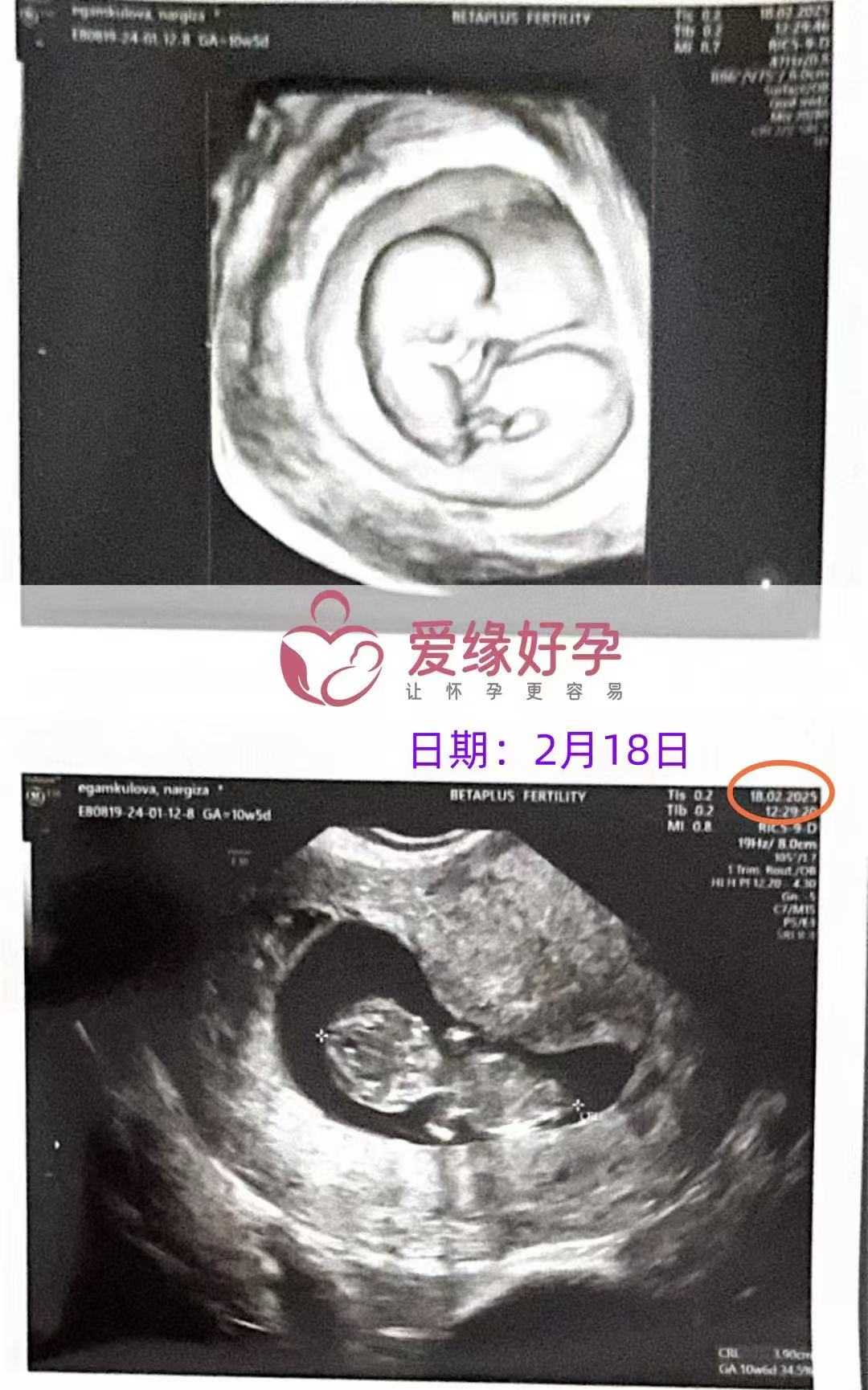 格鲁吉亚代孕代孕代母10周产检顺利通过