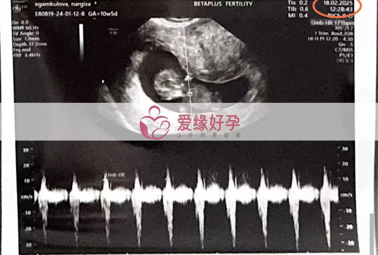 格鲁吉亚代孕代孕代母10周产检顺利通过