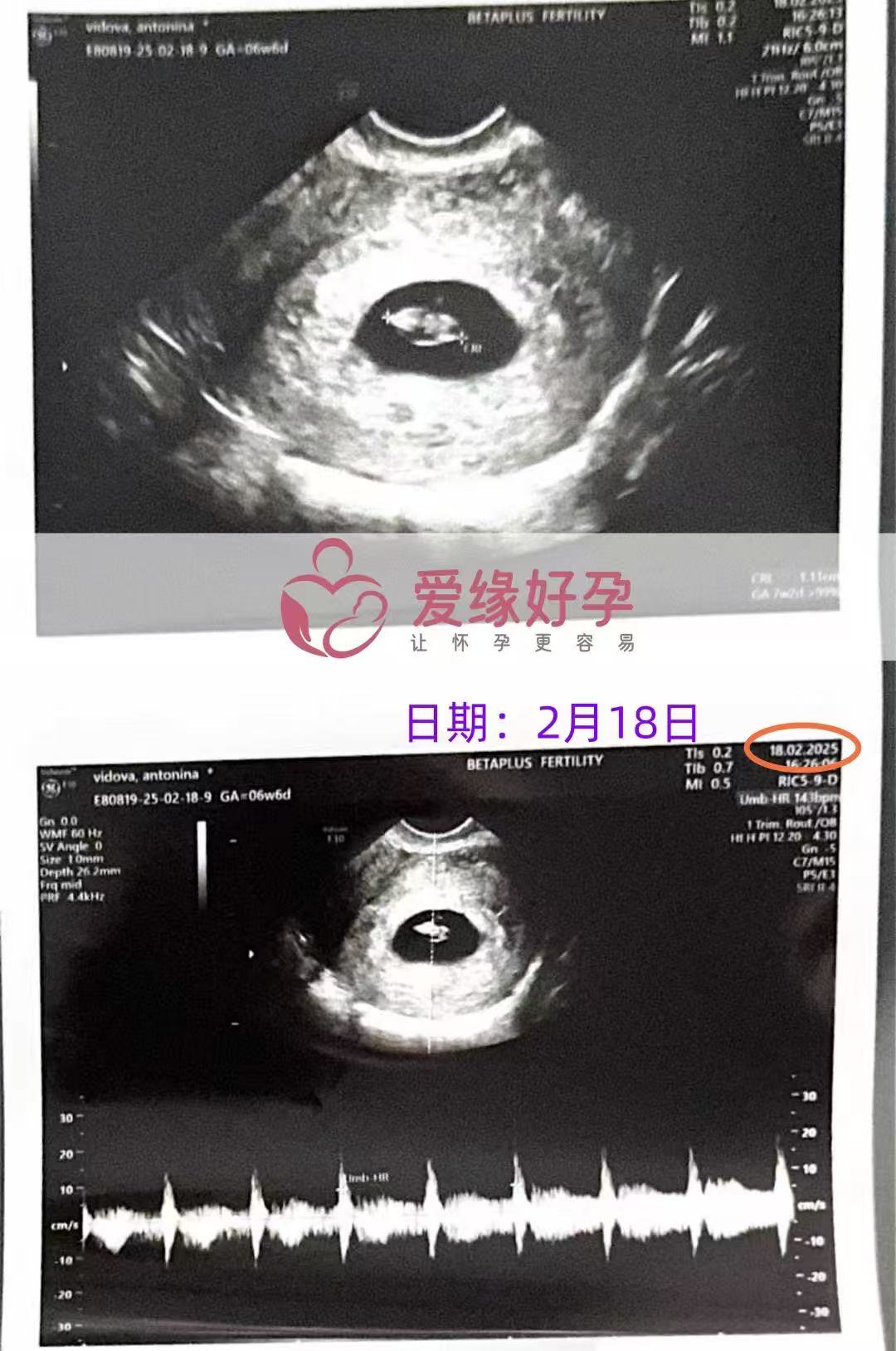 格鲁吉亚代孕代孕代母6周第一次产检完美通过