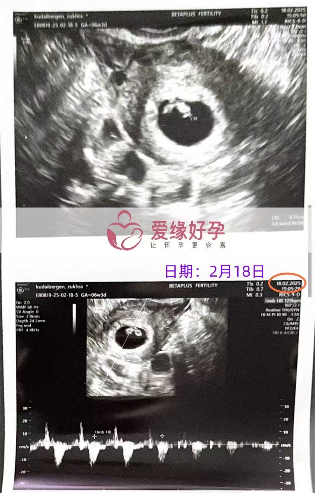 格鲁吉亚代孕代孕代母6周产检通过，孕期迈出第一步