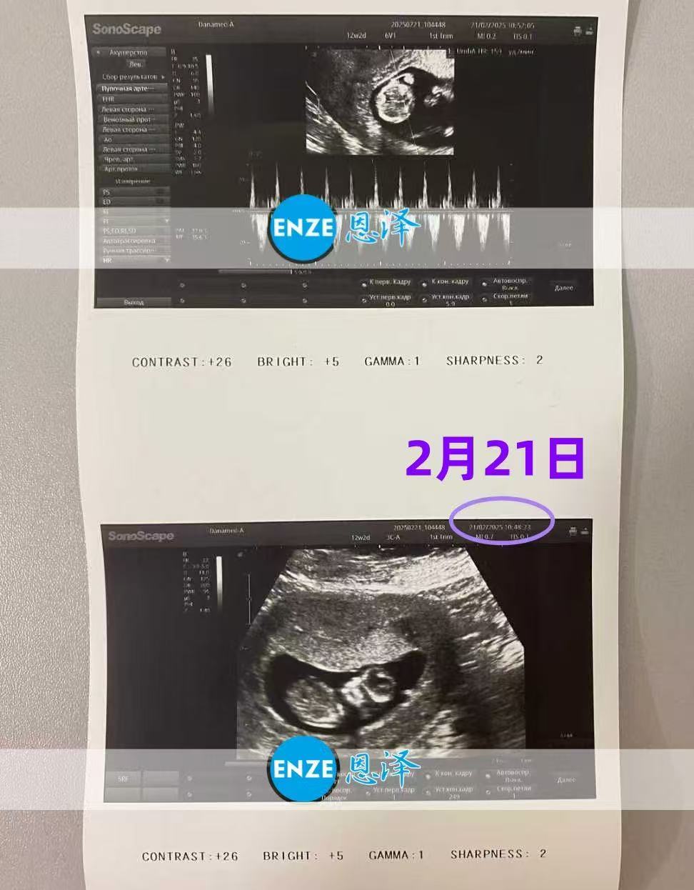 格鲁吉亚代孕代孕代母12周检查通过，迎来稳定期