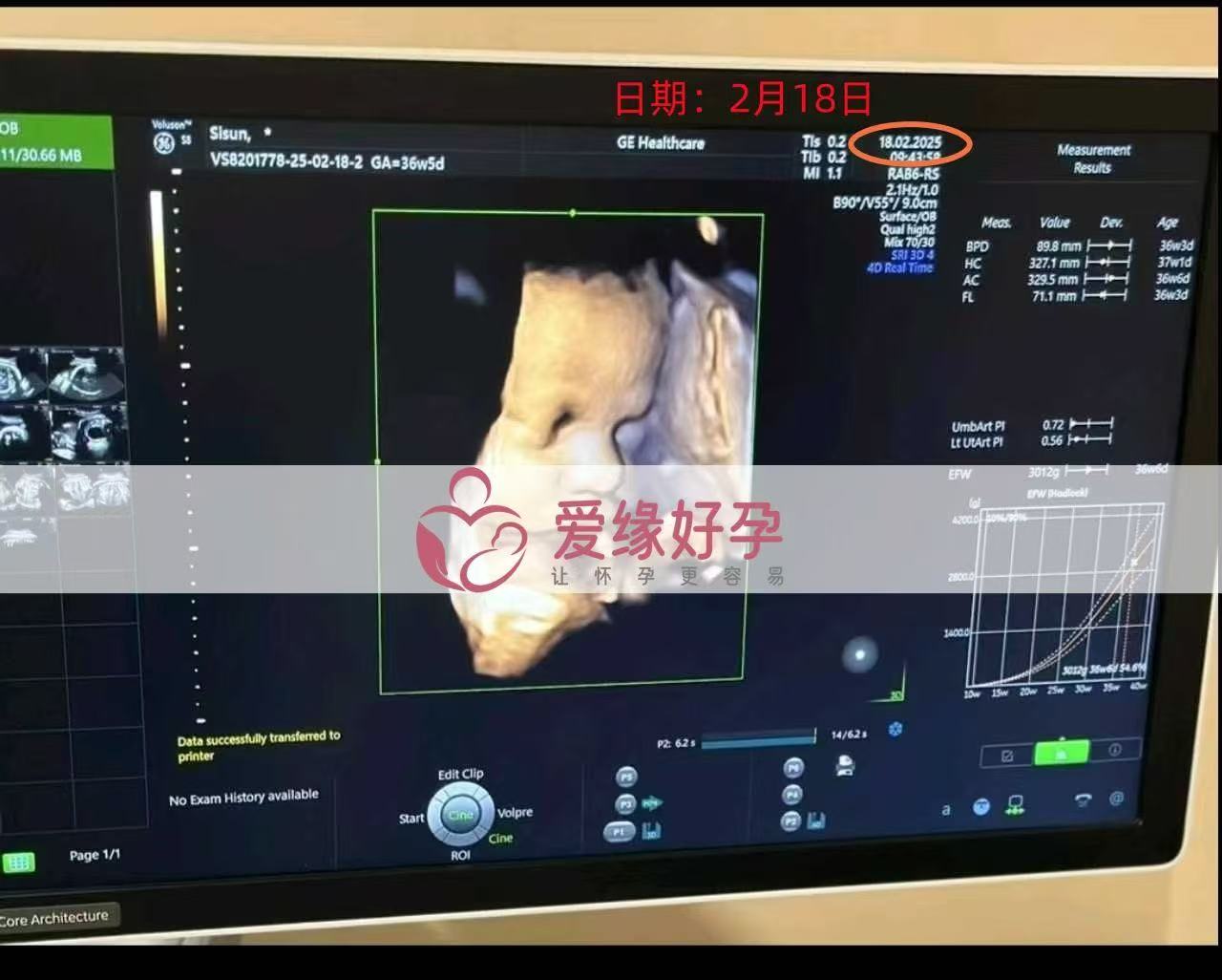 乌克兰代孕代孕代母36周产检顺利，孕期接近尾声