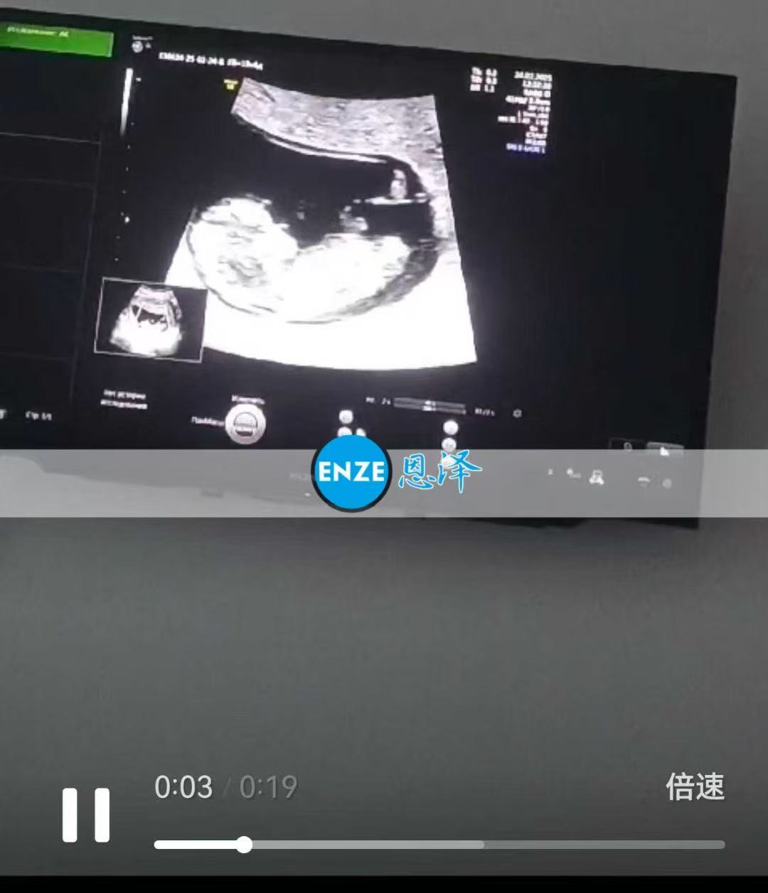 格鲁吉亚代孕代孕代母12周产检通过，顺利进入平稳期