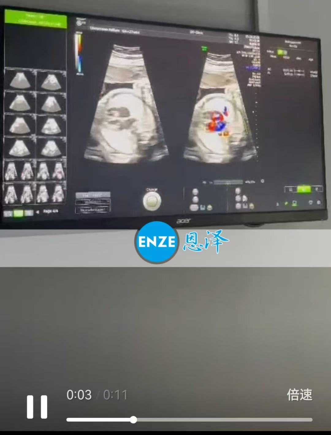格鲁吉亚代孕代孕代母27周产检顺利通过