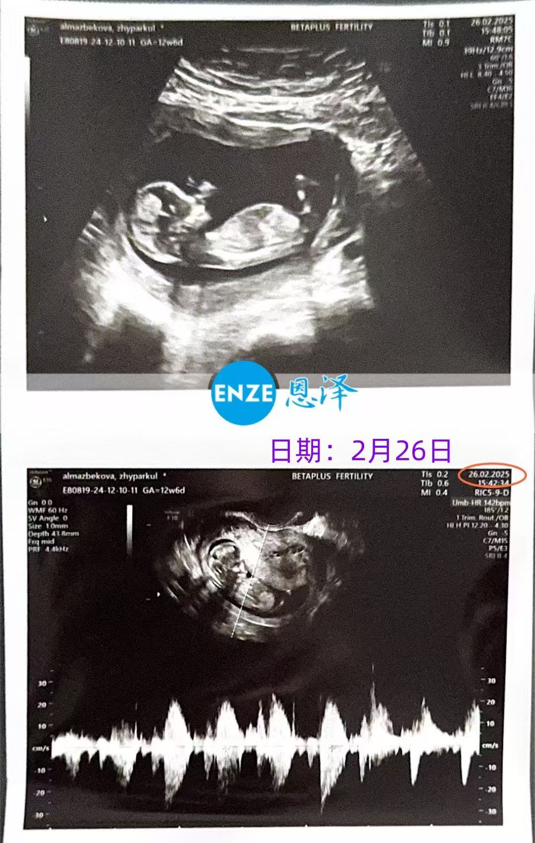 格鲁吉亚代孕代孕代母12周产检通过，平稳度过风险期