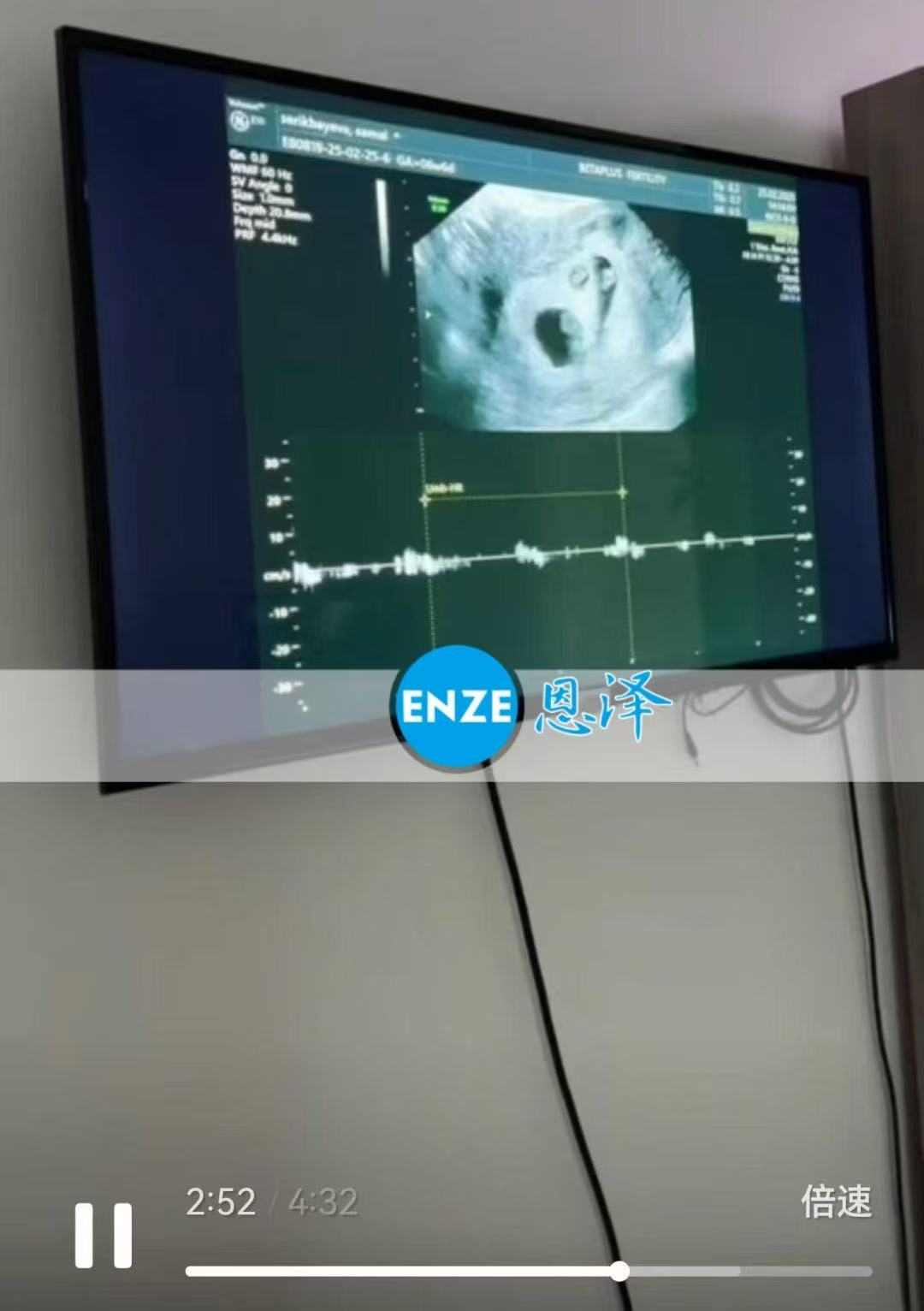 格鲁吉亚代孕代孕代母同卵三胞胎6周检查顺利通过