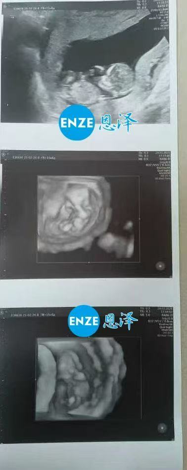 格鲁吉亚代孕代孕代母12周产检通过，顺利进入平稳期
