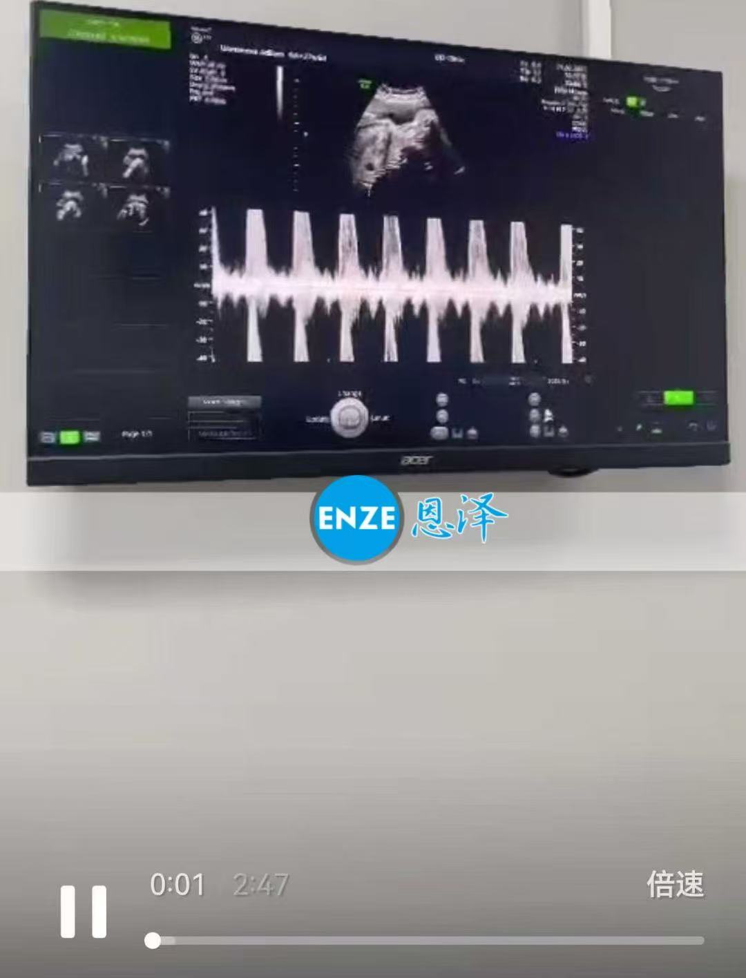 格鲁吉亚代孕代孕代母27周产检顺利通过