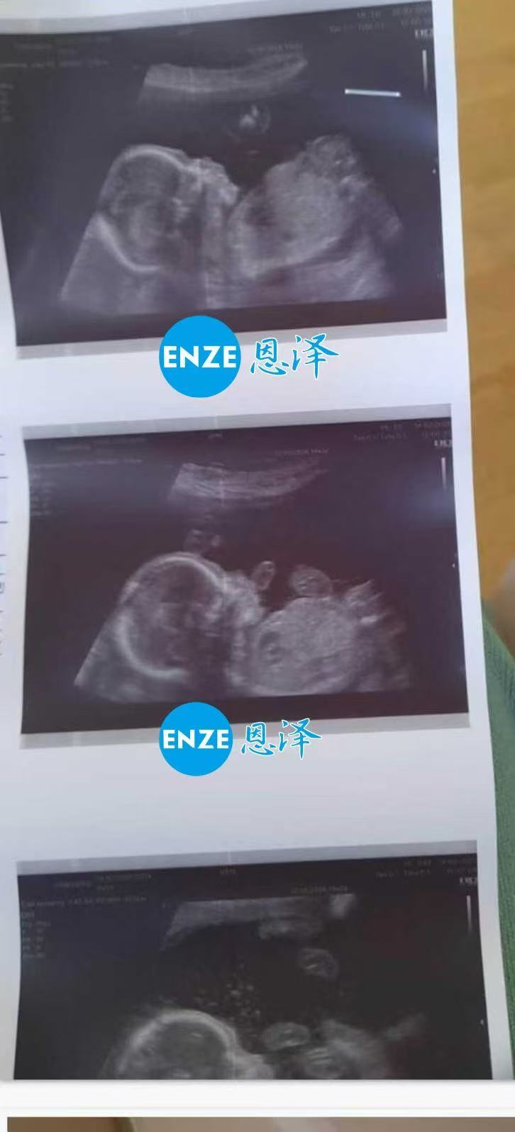 格鲁吉亚代孕代孕代母19周产检顺利通过