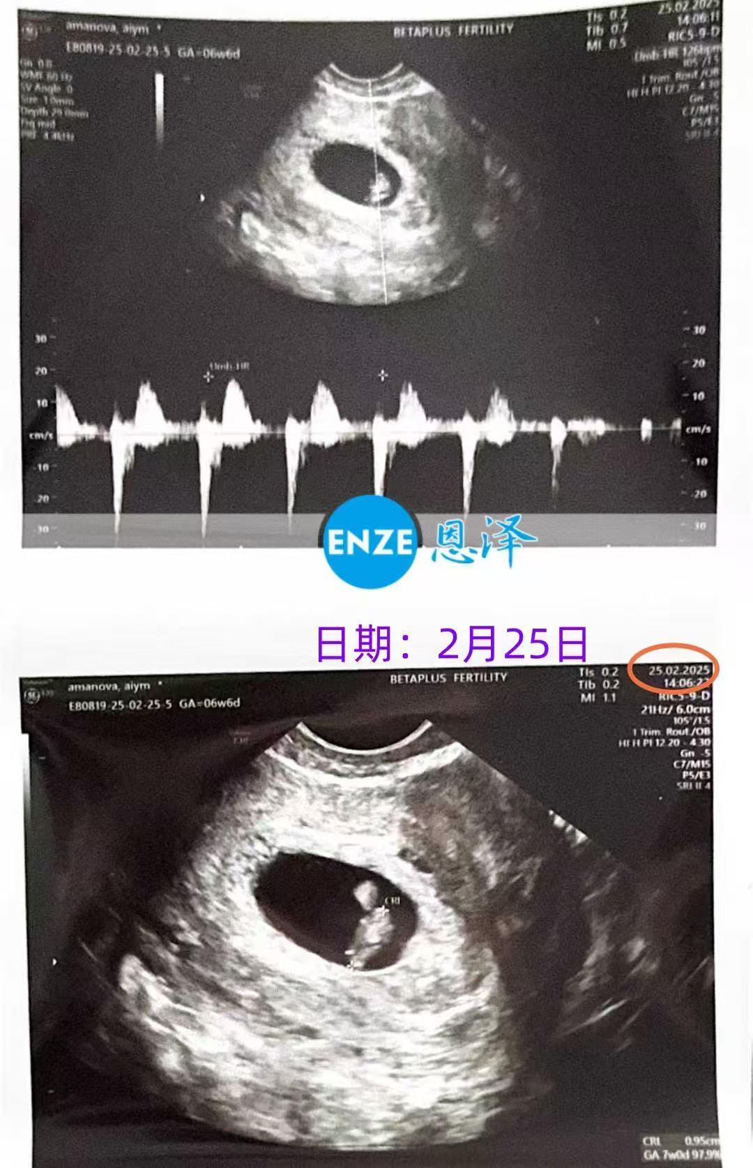 格鲁吉亚代孕代孕代母6周产检顺利通过