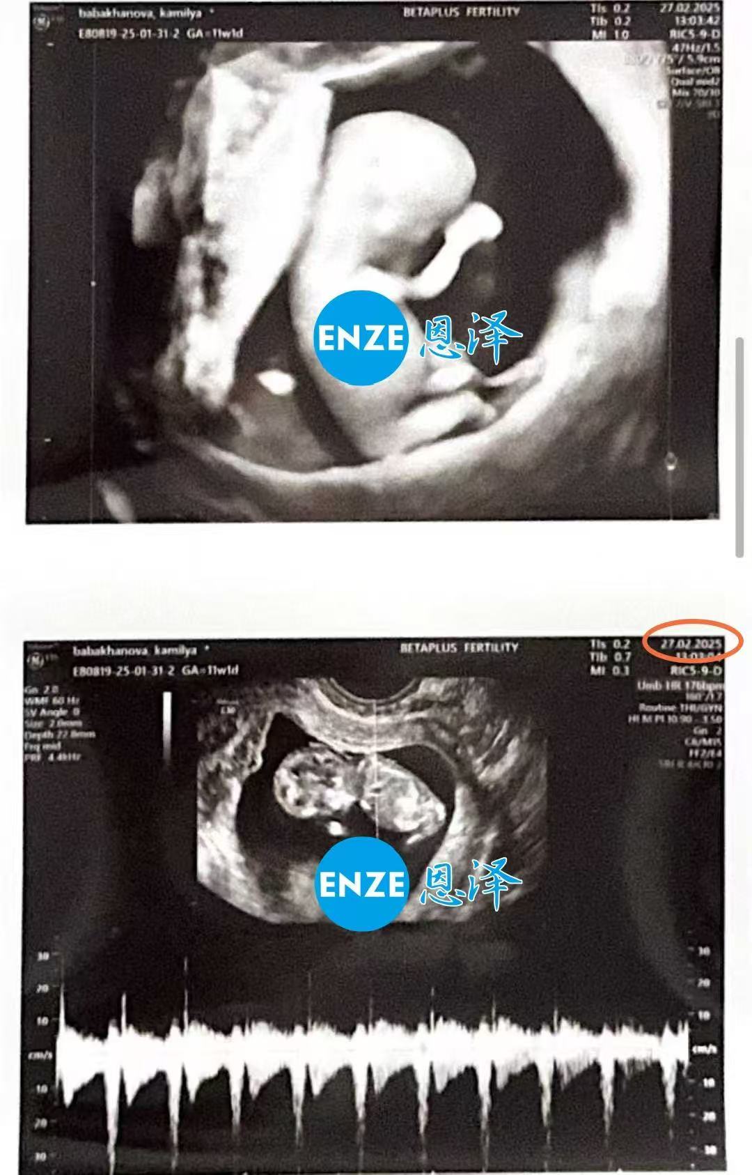 格鲁吉亚代孕代孕代母11周产检进展顺利