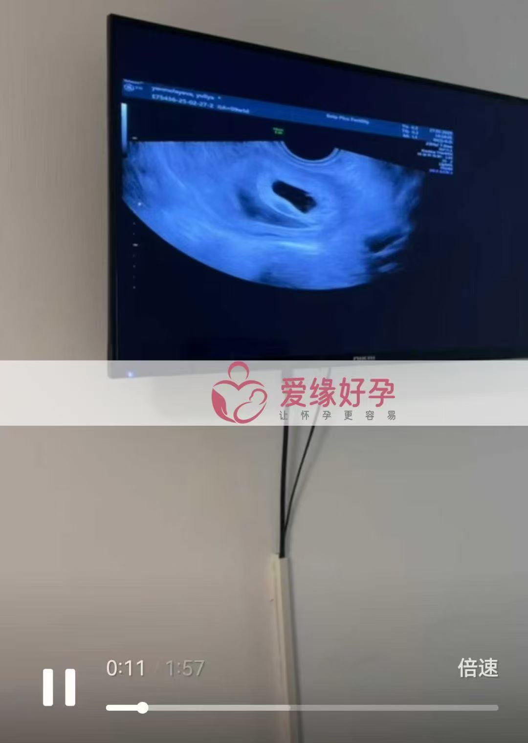 格鲁吉亚代孕代孕代母6周产检顺利通过