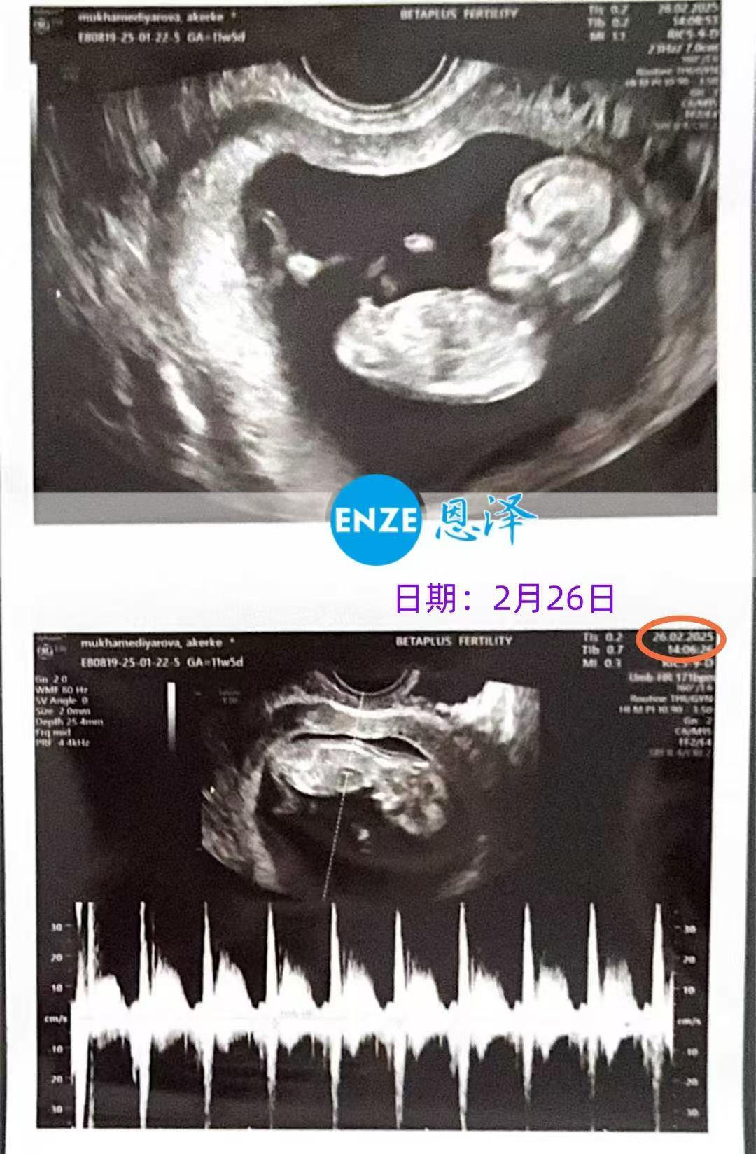 格鲁吉亚代孕代孕代母12周产检过关，正式度过风险期