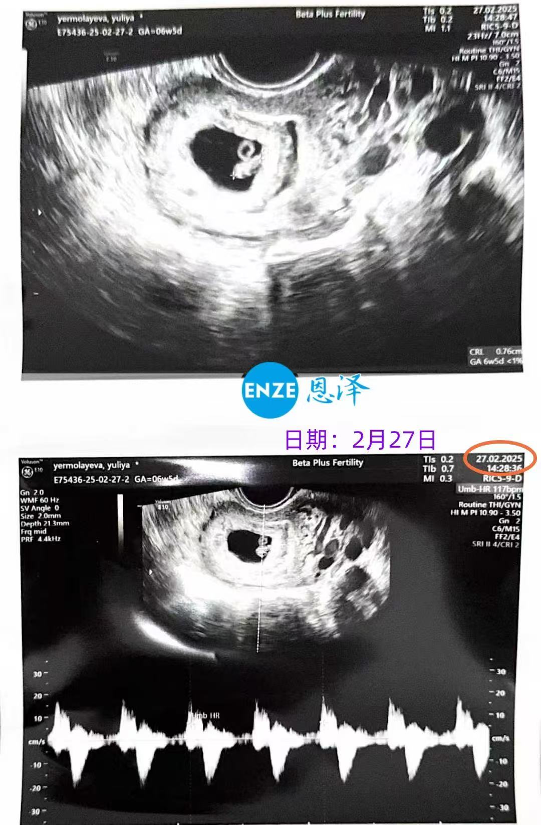 格鲁吉亚代孕代孕代母6周产检顺利通过