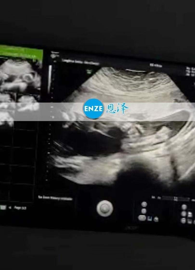 格鲁吉亚代孕代孕代母21周产检顺利通过