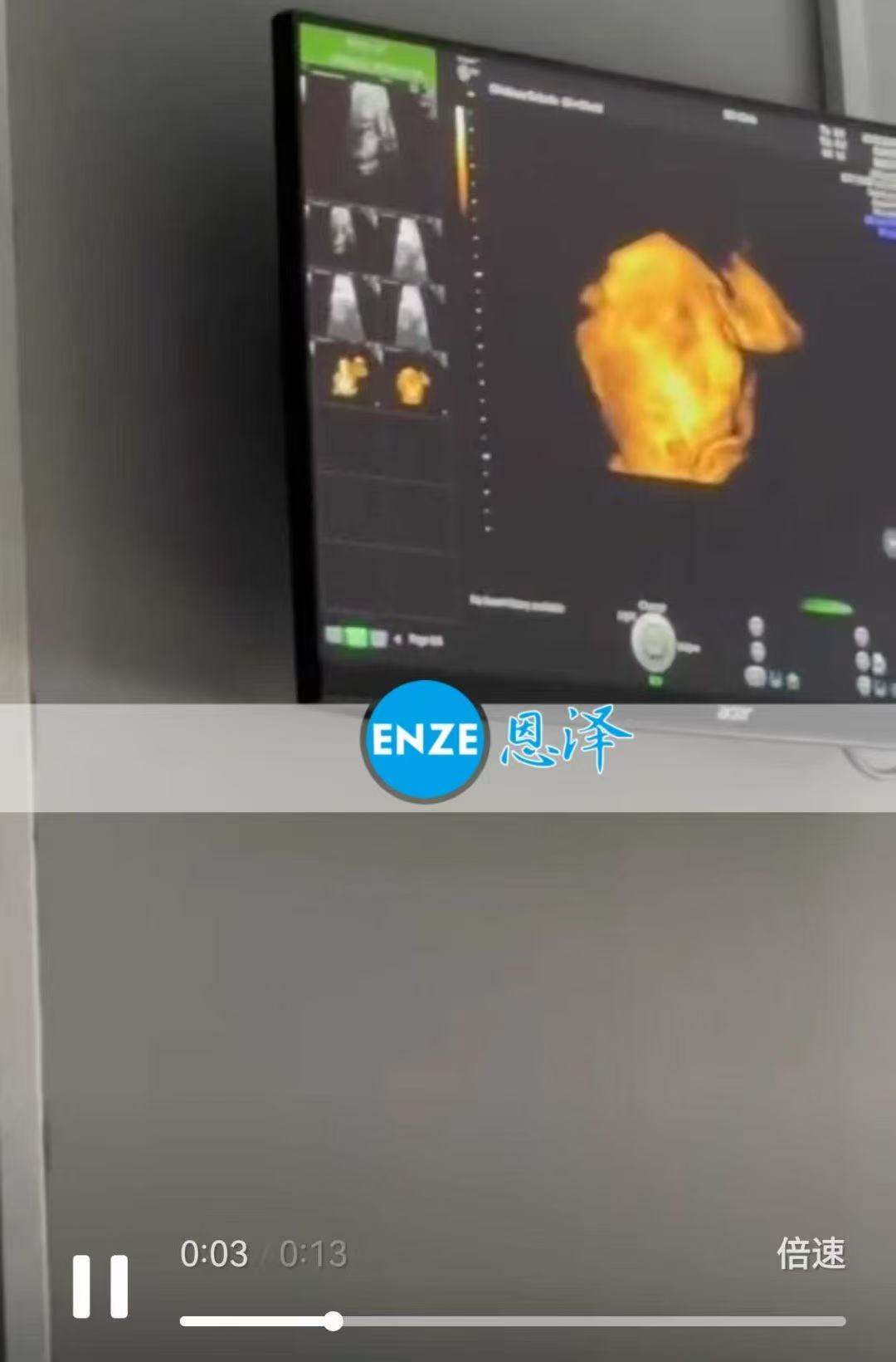 格鲁吉亚代孕代孕代母30周产检顺利通过
