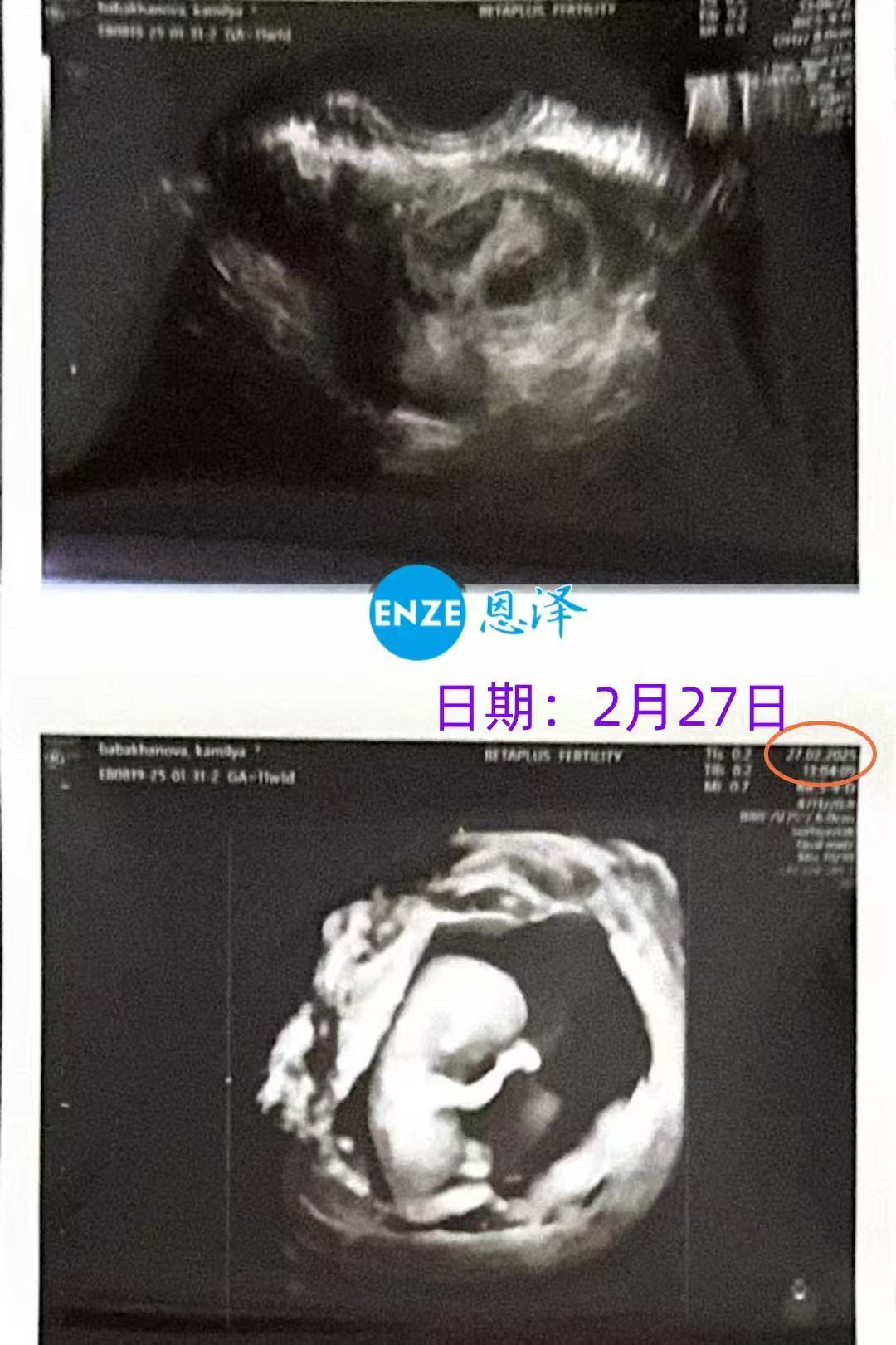 格鲁吉亚代孕代孕代母11周产检进展顺利