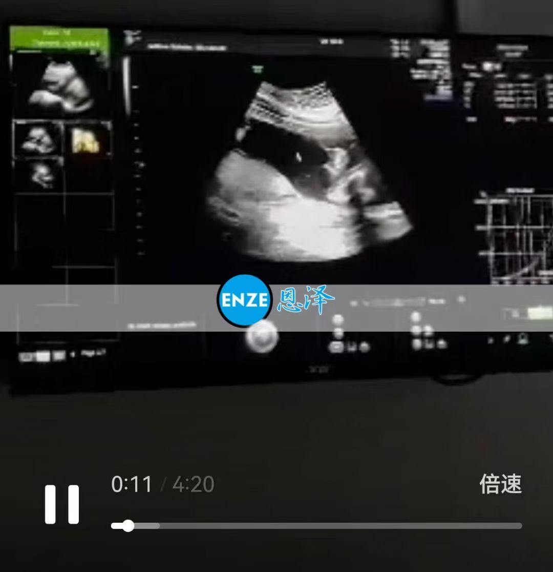 格鲁吉亚代孕代孕代母22周产检顺利通过