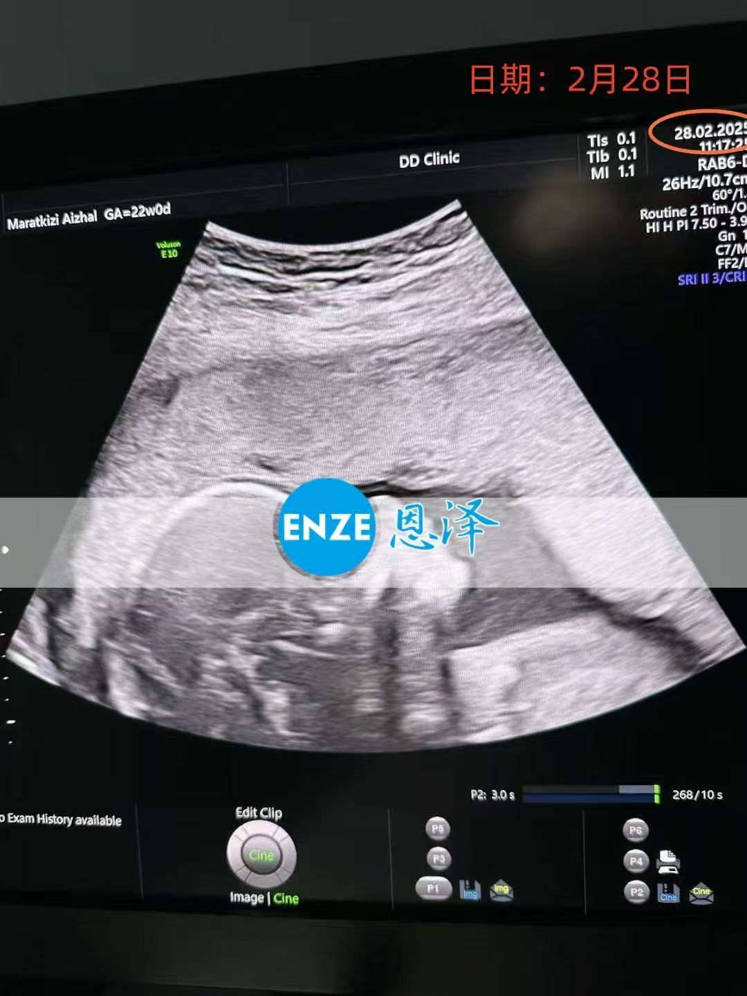格鲁吉亚代孕代孕代母22周产检顺利通过