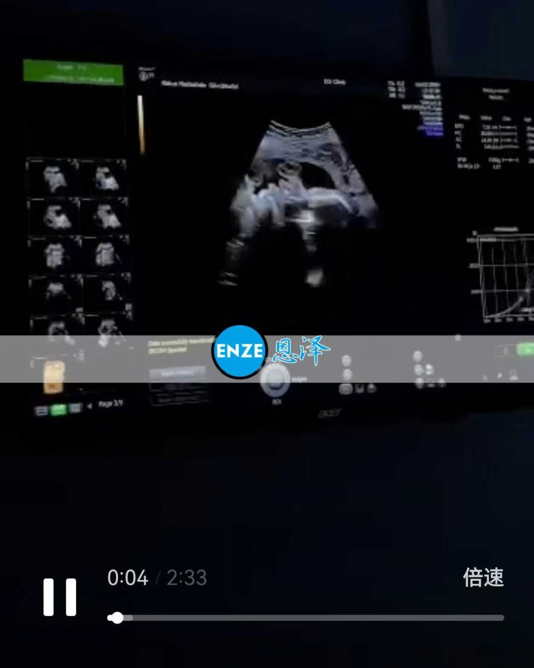格鲁吉亚代孕代孕代母29周产检进展顺利