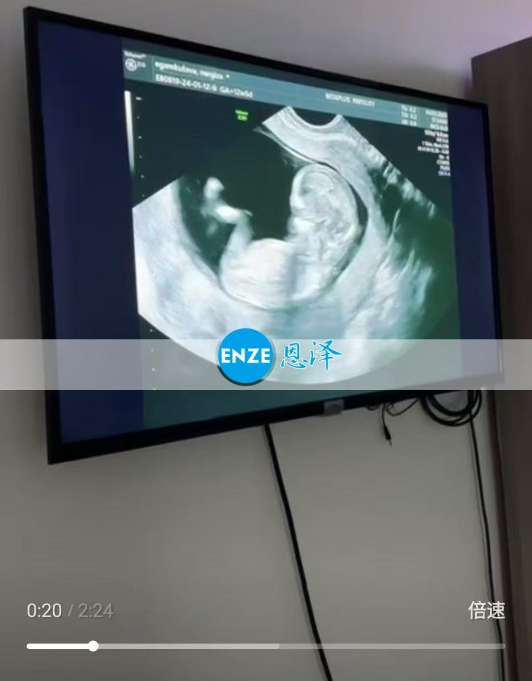 格鲁吉亚代孕代孕代母通过12周产检，正式进入稳定期