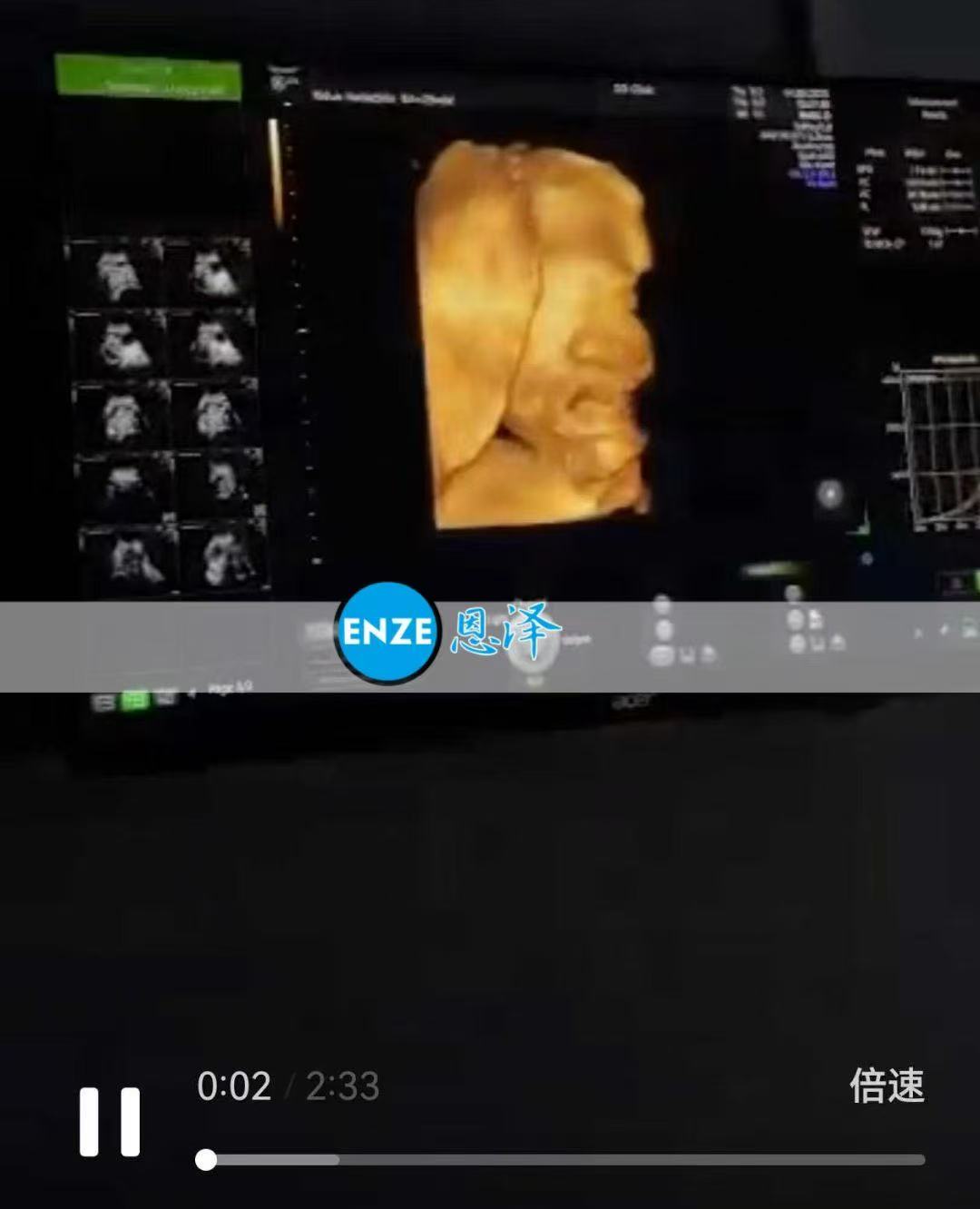 格鲁吉亚代孕代孕代母29周产检进展顺利