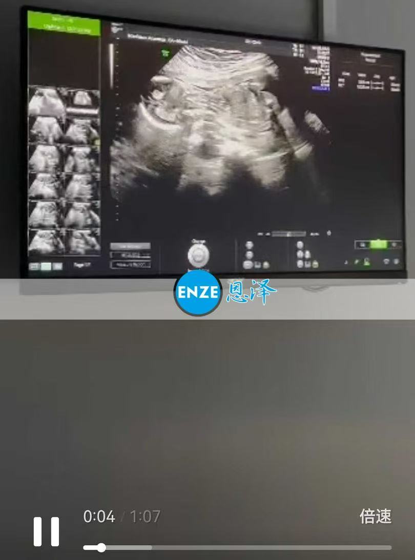 格鲁吉亚代孕代孕代母17周产检顺利过关