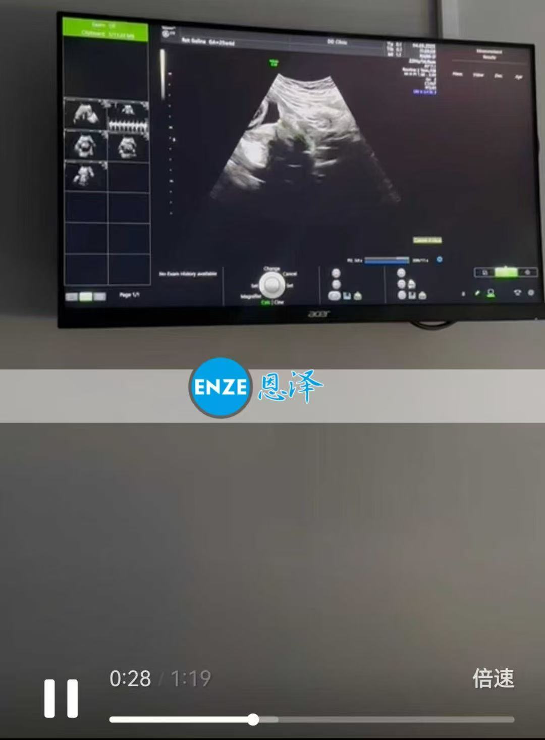 格鲁吉亚代孕代孕代母顺利完成25周产检