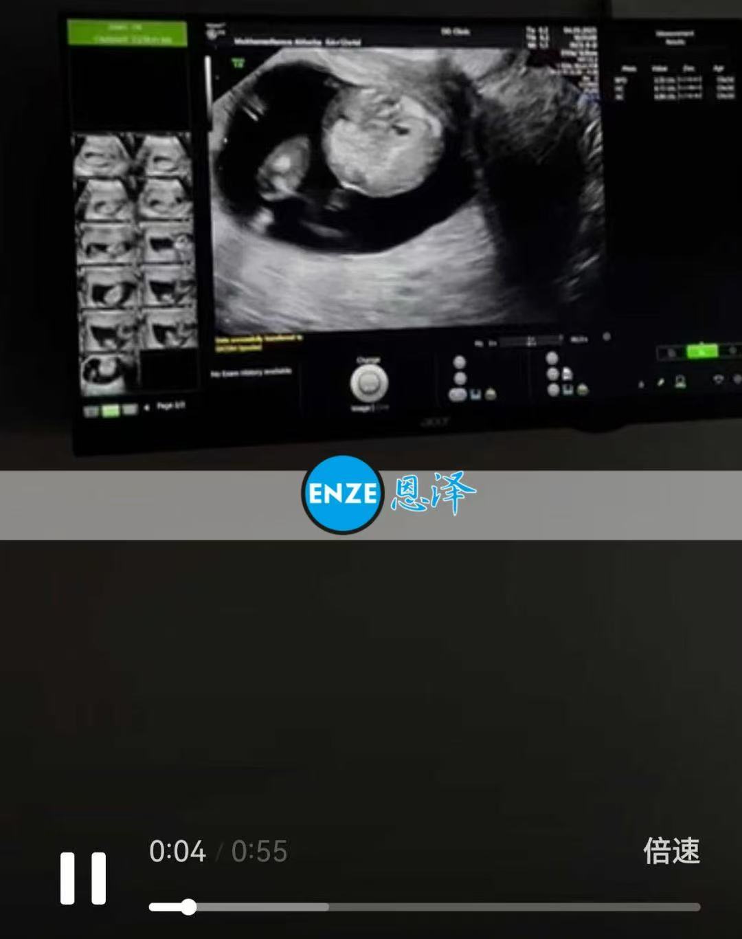 格鲁吉亚代孕代孕代母12周产检顺利，正式进入稳定期