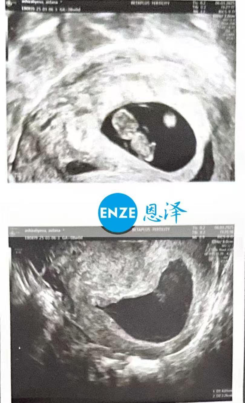 格鲁吉亚代孕代孕代母8周产检进展顺利
