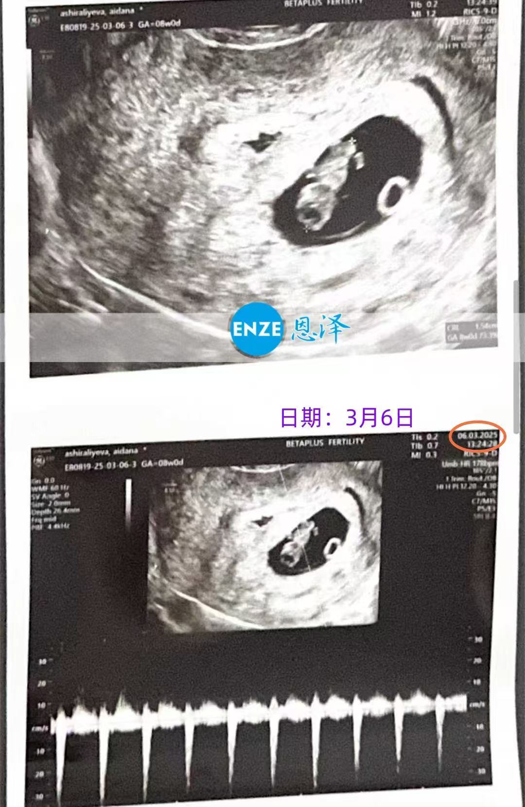 格鲁吉亚代孕代孕代母8周产检进展顺利