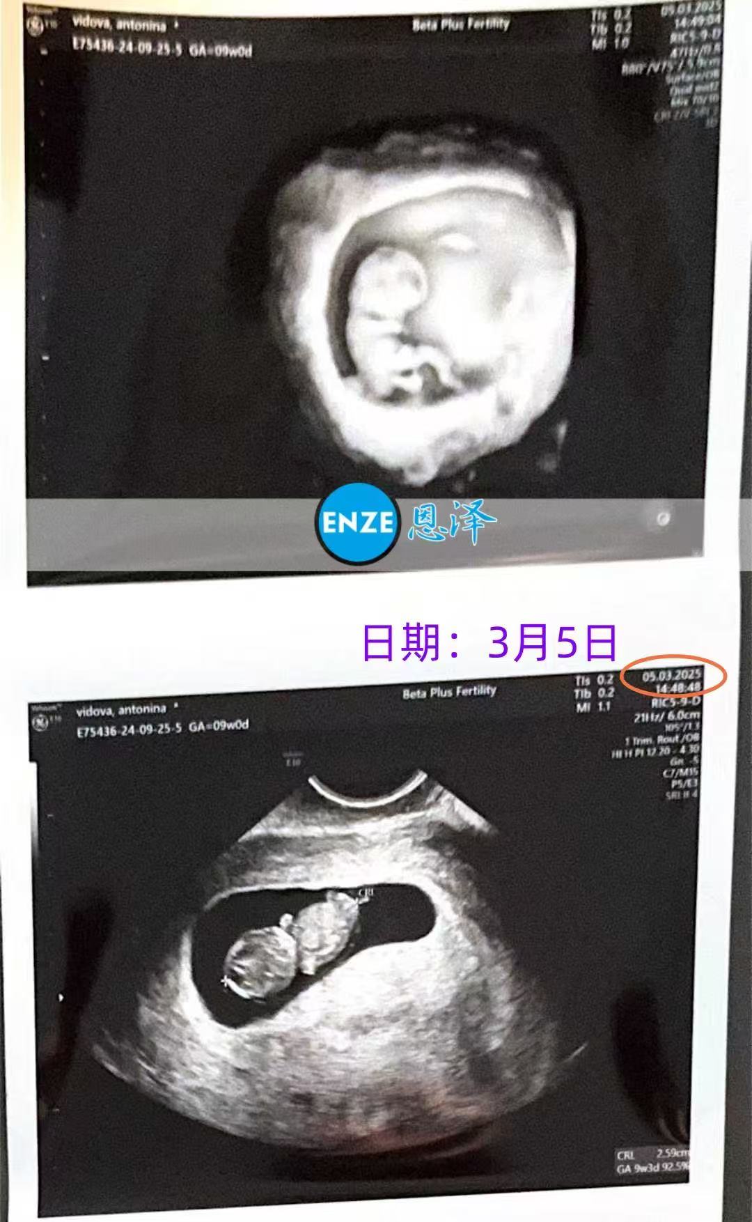 格鲁吉亚代孕代孕代母9周产检顺利通过