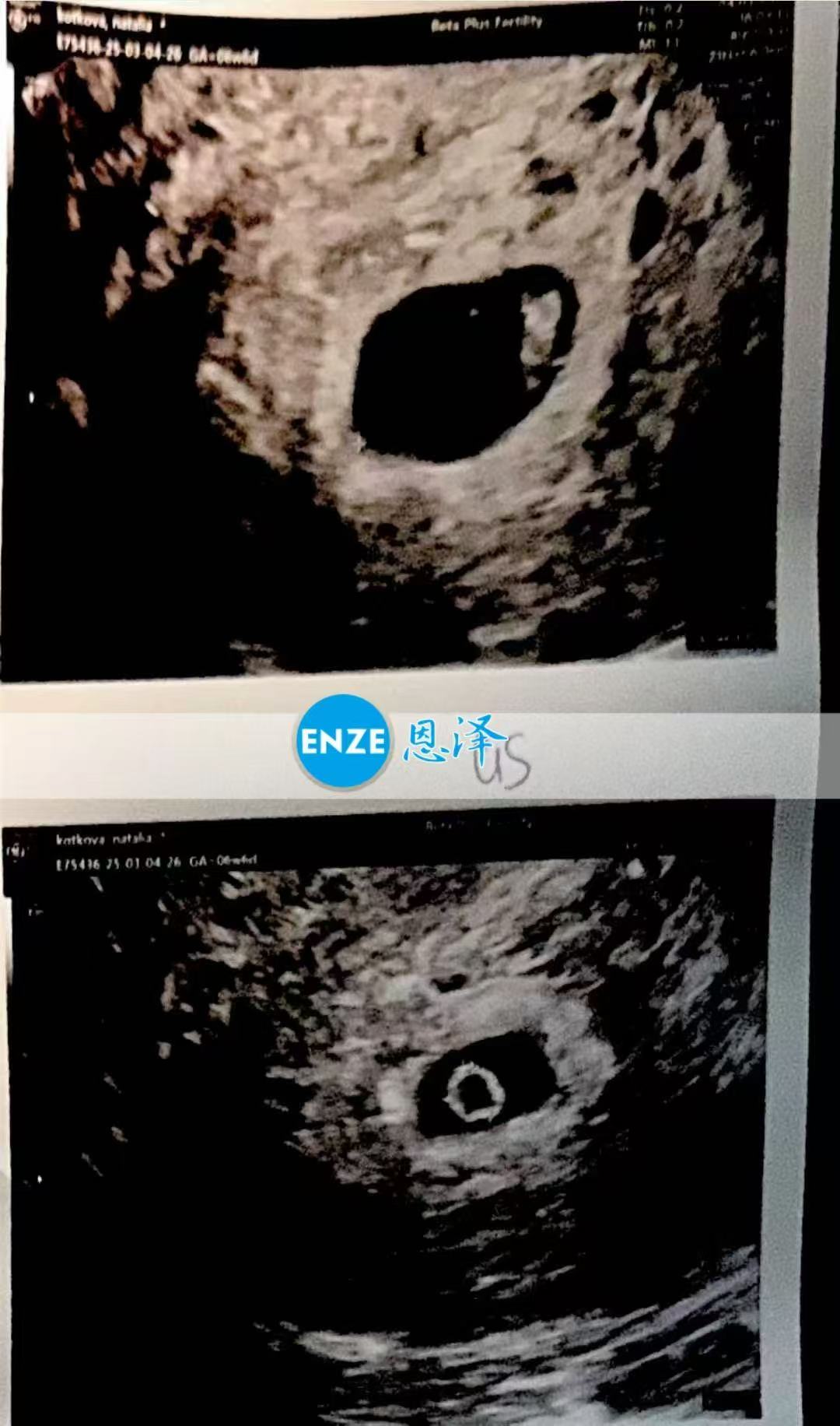 格鲁吉亚代孕代孕代母6周第一次产检顺利通过