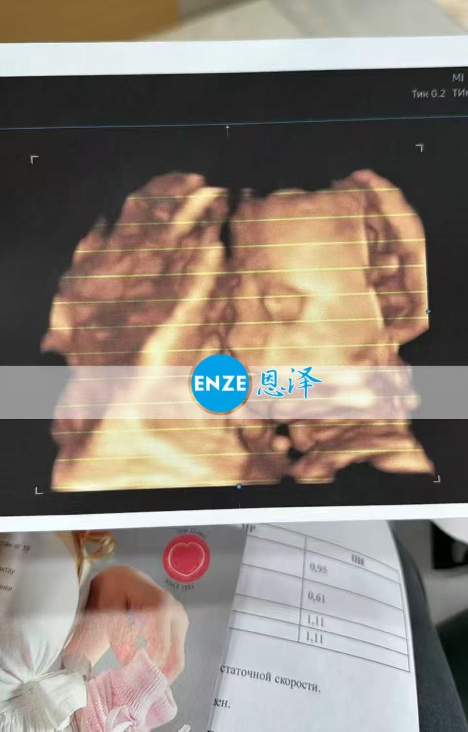 哈萨克斯坦代孕代孕代母24周产检顺利通过