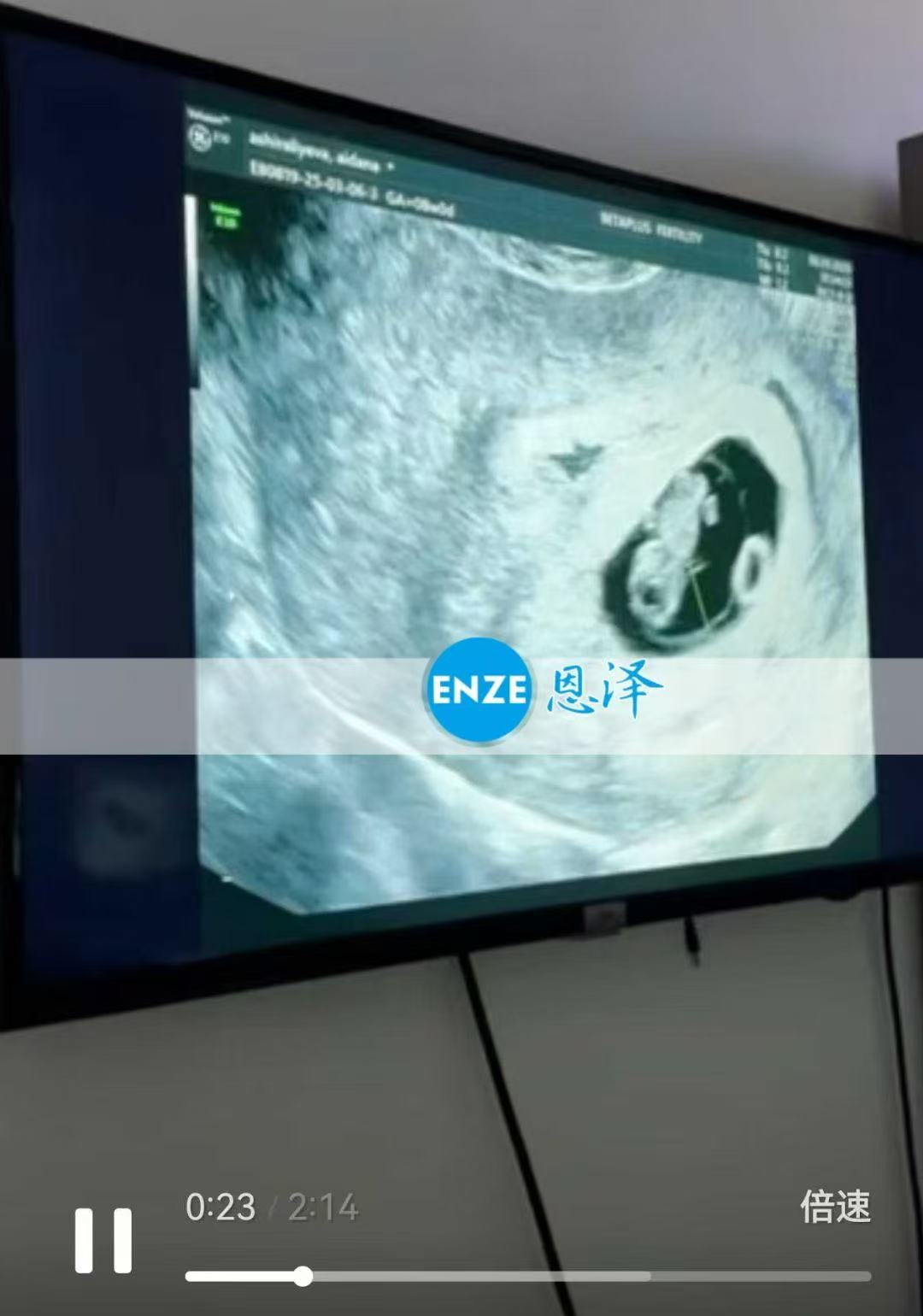 格鲁吉亚代孕代孕代母8周产检进展顺利