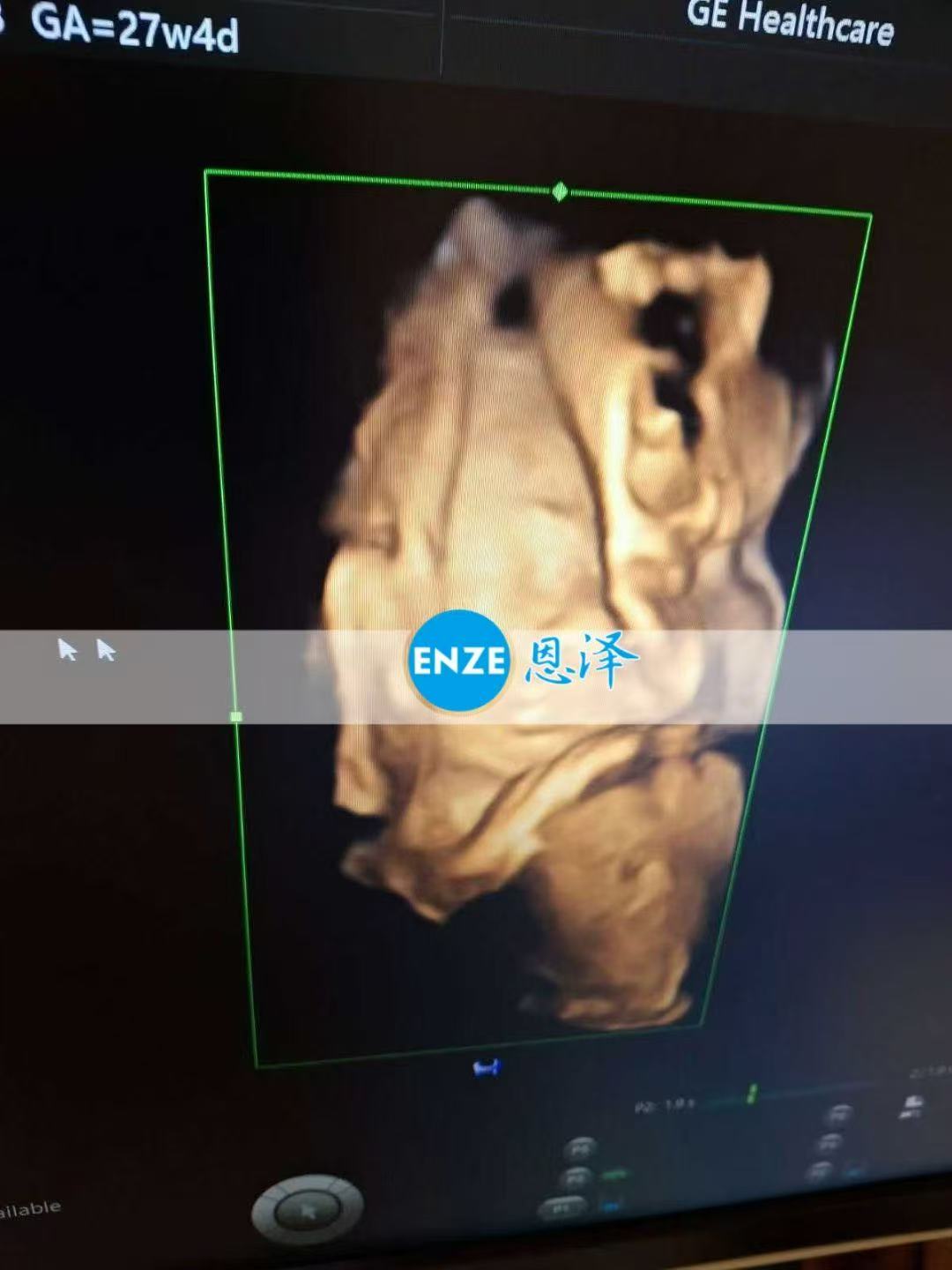 乌克兰代孕代孕代母顺利通过27周产检