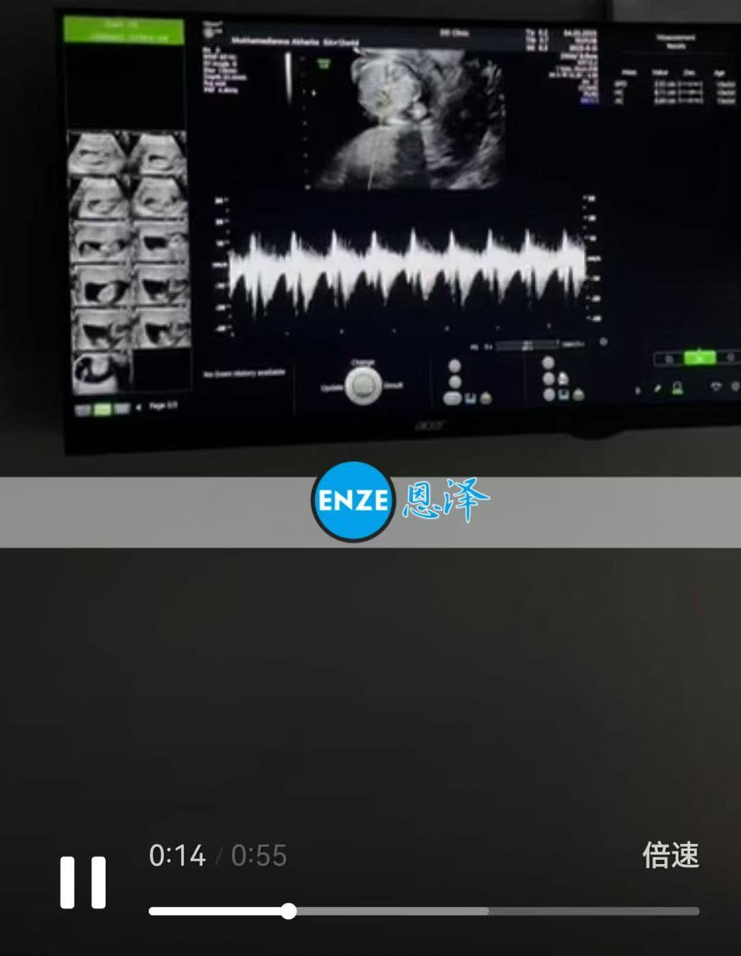 格鲁吉亚代孕代孕代母12周产检顺利，正式进入稳定期